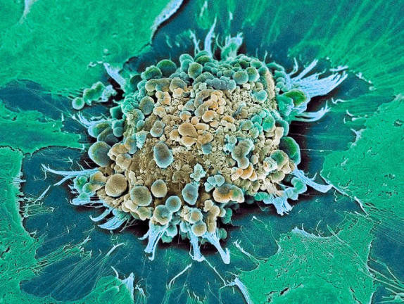 Раковая клетка в апоптозе
