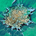 Раковая клетка в апоптозе.jpg